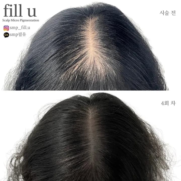 가르마 커버 밀도보강 SMP 두피문신