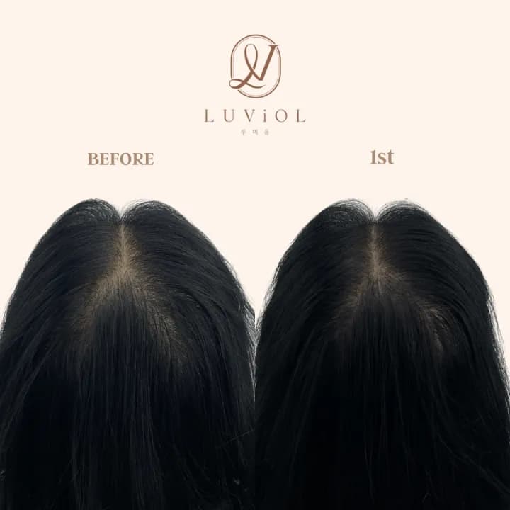 정수리 밀도보강 1회차