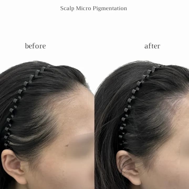 넓은이마 쉐딩헤어라인