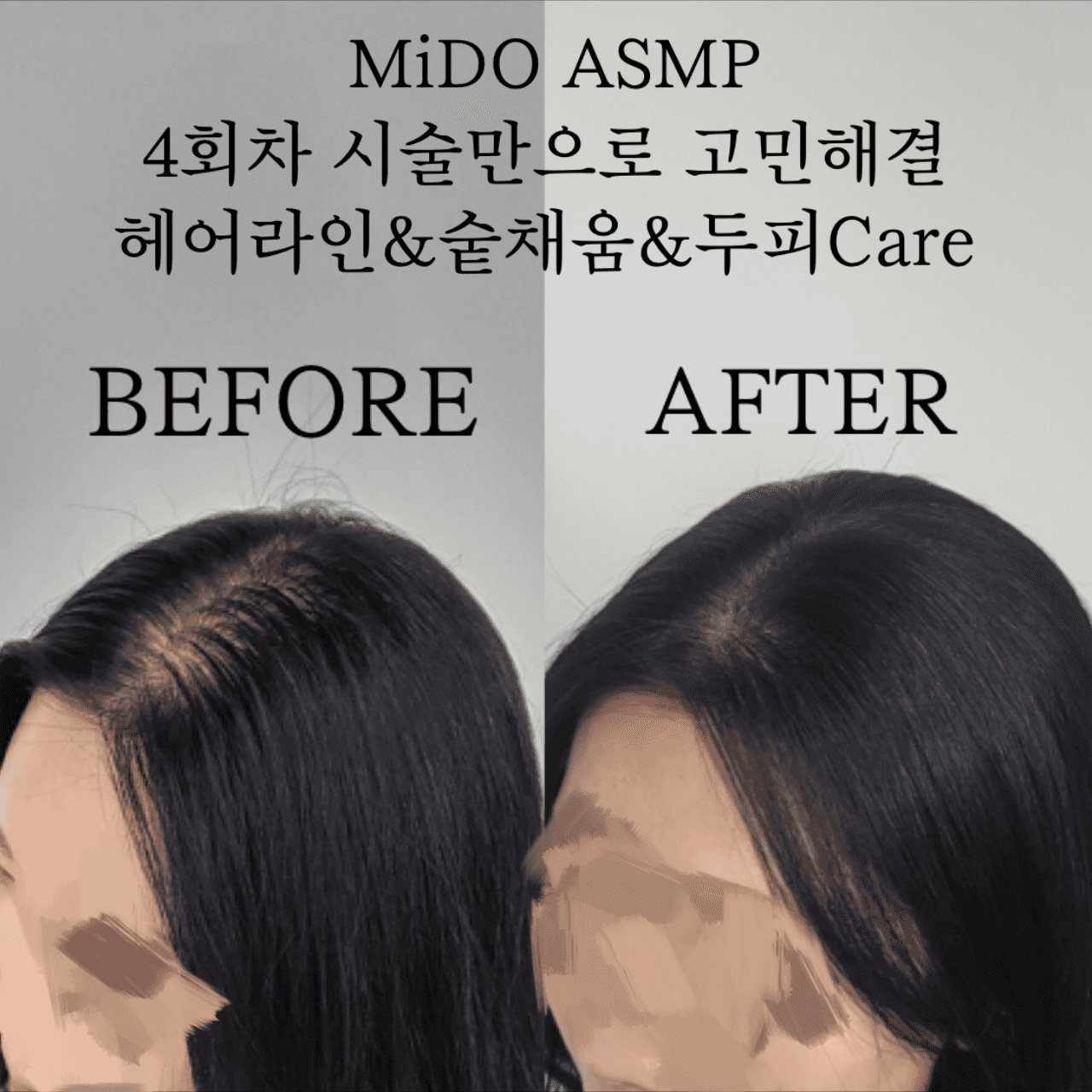 산후탈모 정수리 숱채움&헤어라인 MTS두피Care