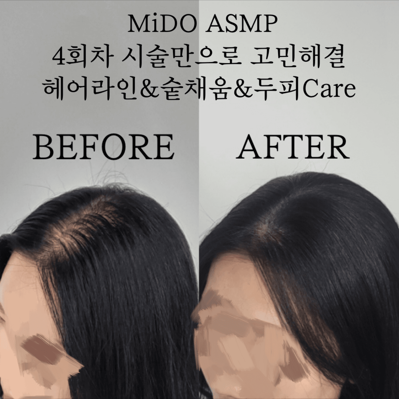 산후탈모 정수리 숱채움&헤어라인 MTS두피Care
