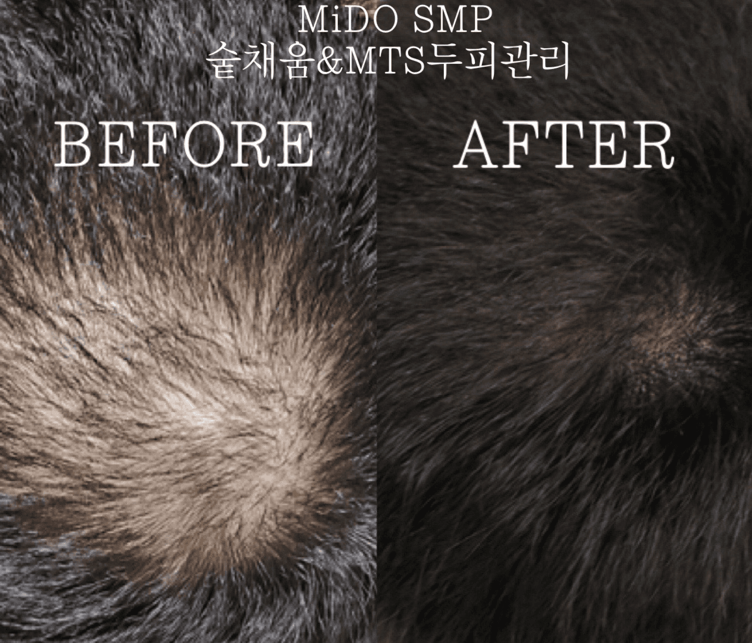SMP남성숱채움&MTS두피Care
