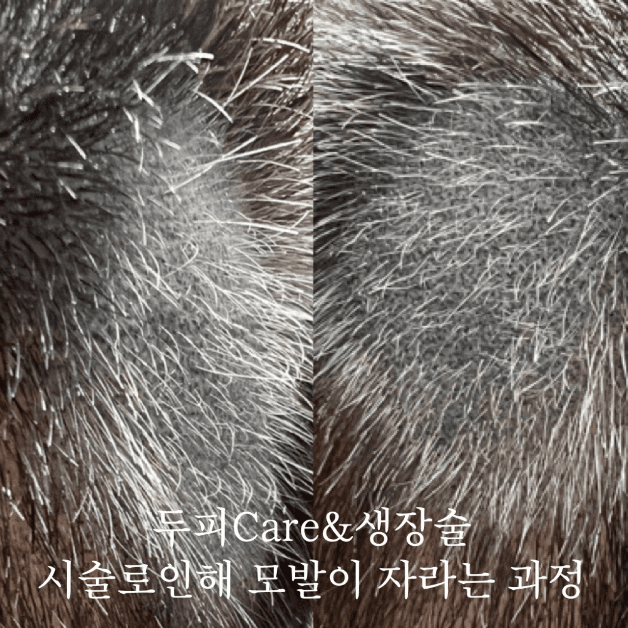 SMP반흔성탈모&MTS두피Care&모발생장술&수술흉터커버