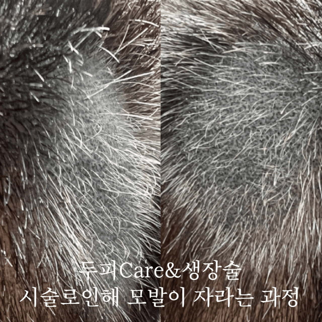 SMP반흔성탈모&MTS두피Care&모발생장술&수술흉터커버