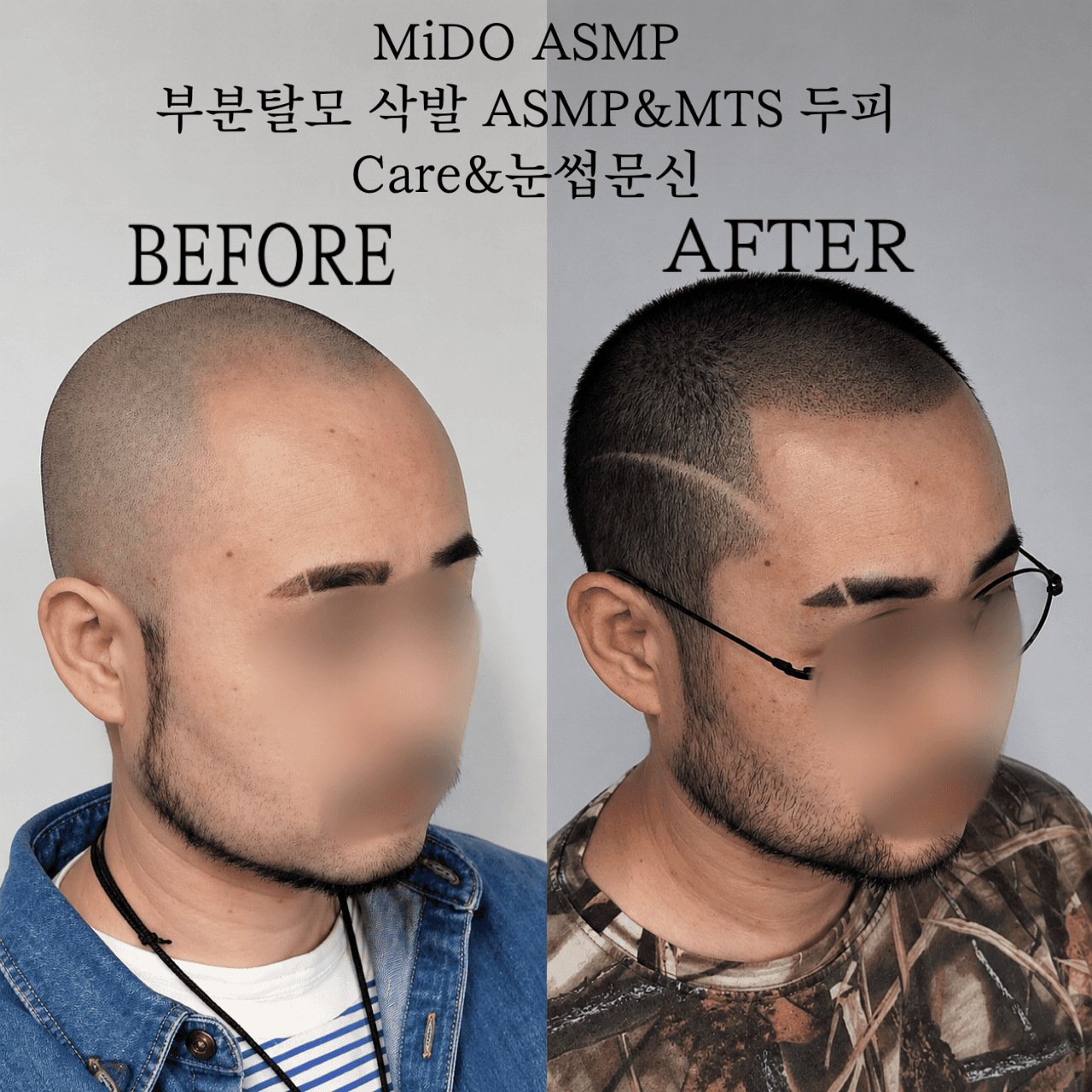 ASMP전체삭발&MTS두피Care