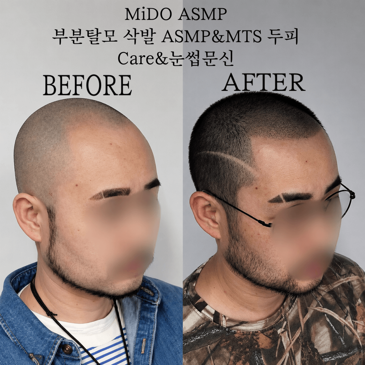 ASMP전체삭발&MTS두피Care
