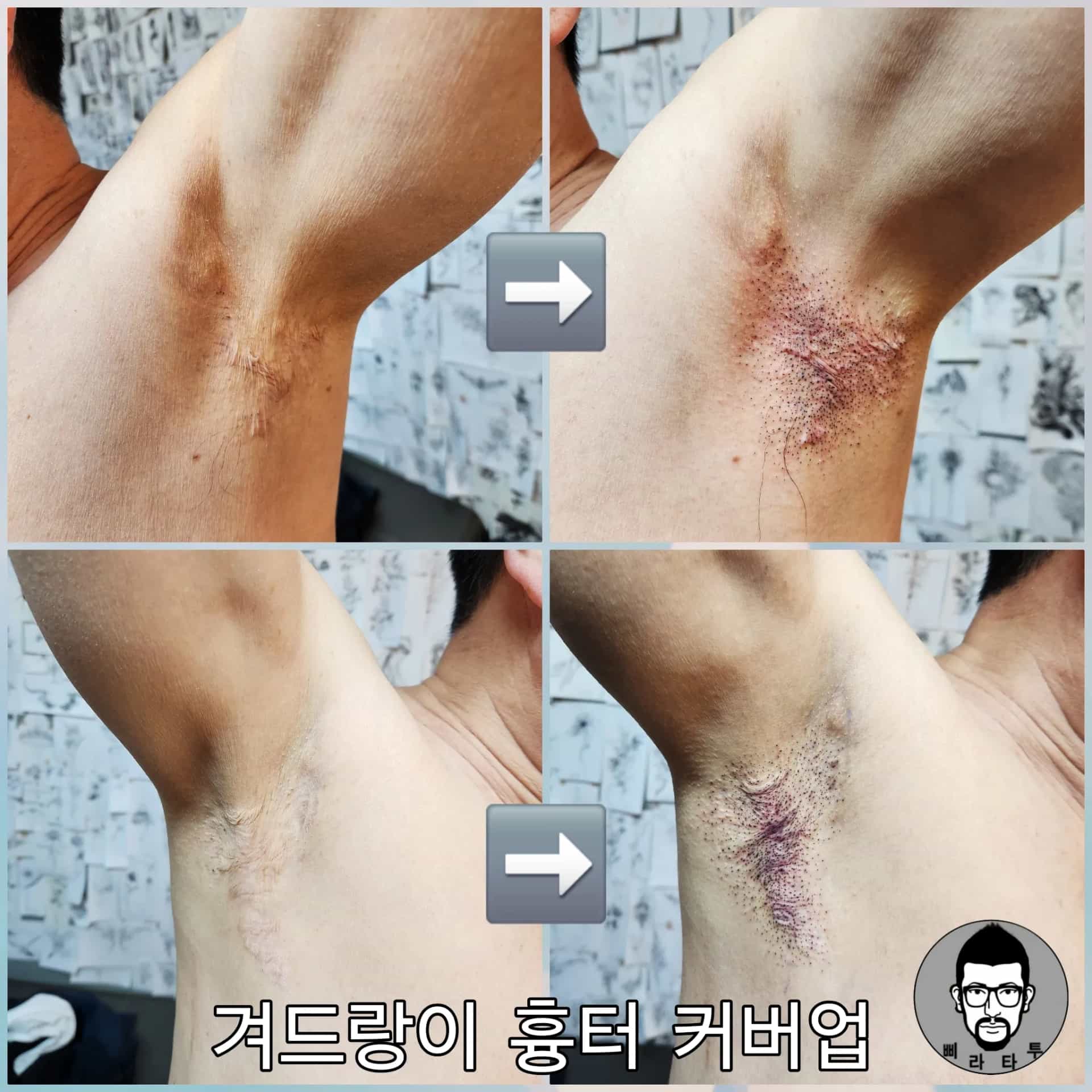 흉터커버업