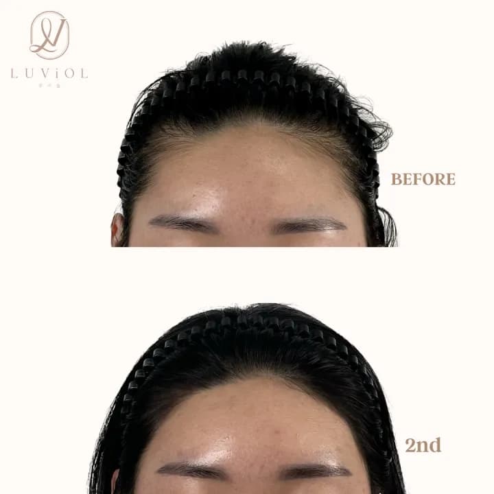 헤어라인 반영구+요청시 왁싱sv