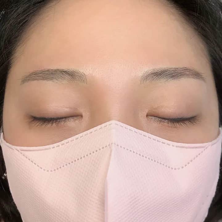 비대칭 눈썹 교정