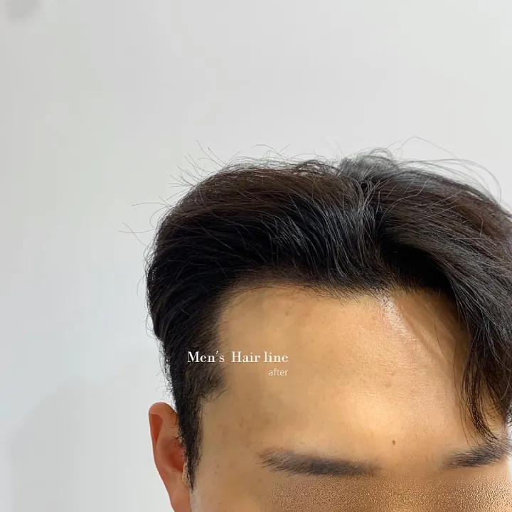 남성헤어라인) 두피문신 SMP