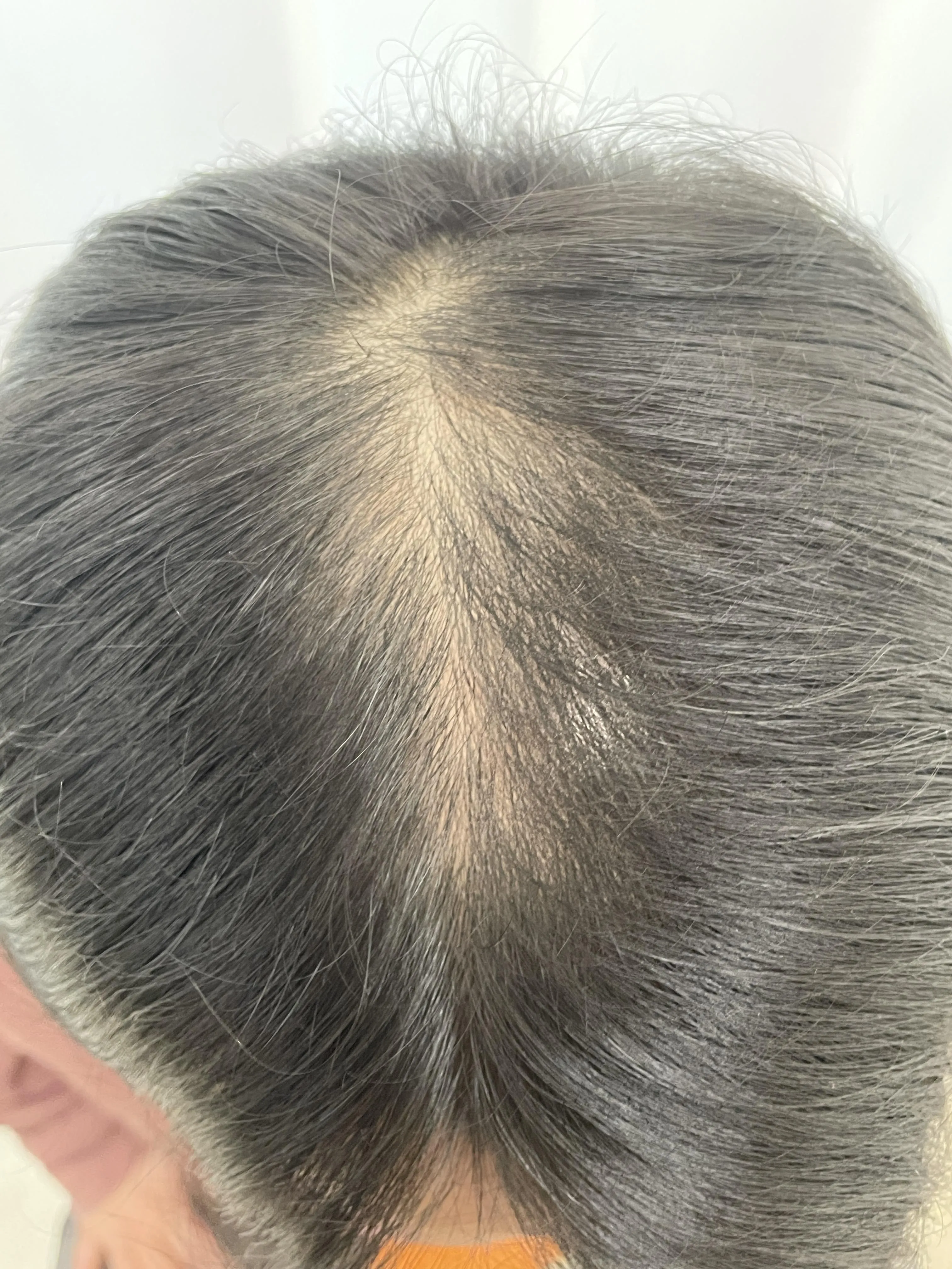 가르마 숱보강 시술