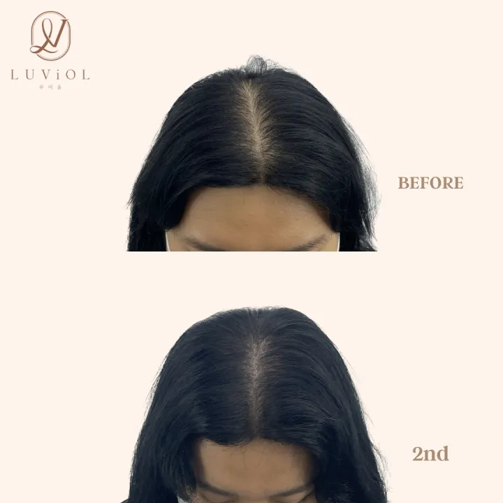 가르마 밀도보강 2차 전후 (카톡 플친 추가 시 40%)