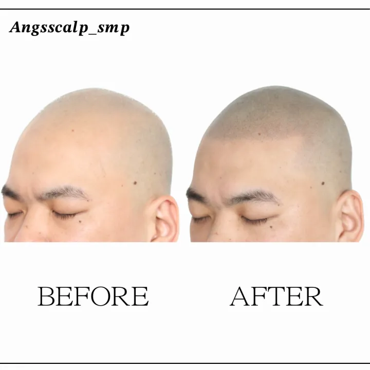 ๋ฏผ๋จธ๋ฆฌ ์ ์ฒดํ๋ชจ ๋ํผ๋ฌธ์