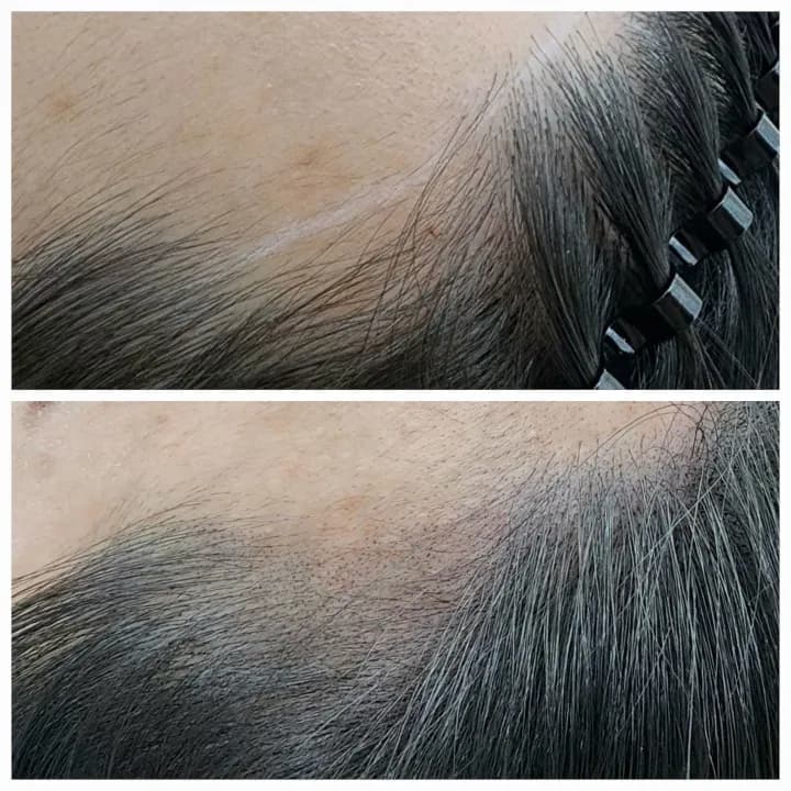 헤어라인 두피문신