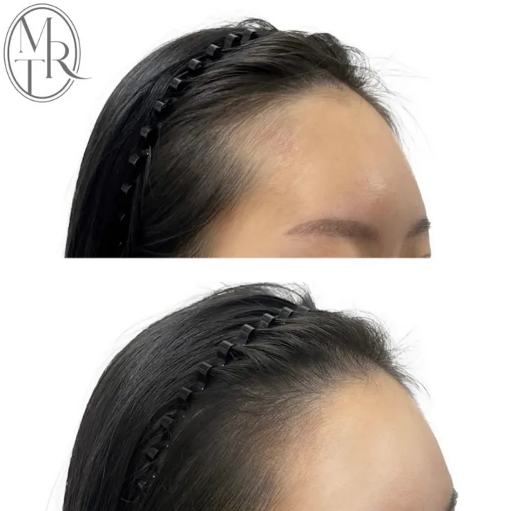 여성 헤어라인 커버