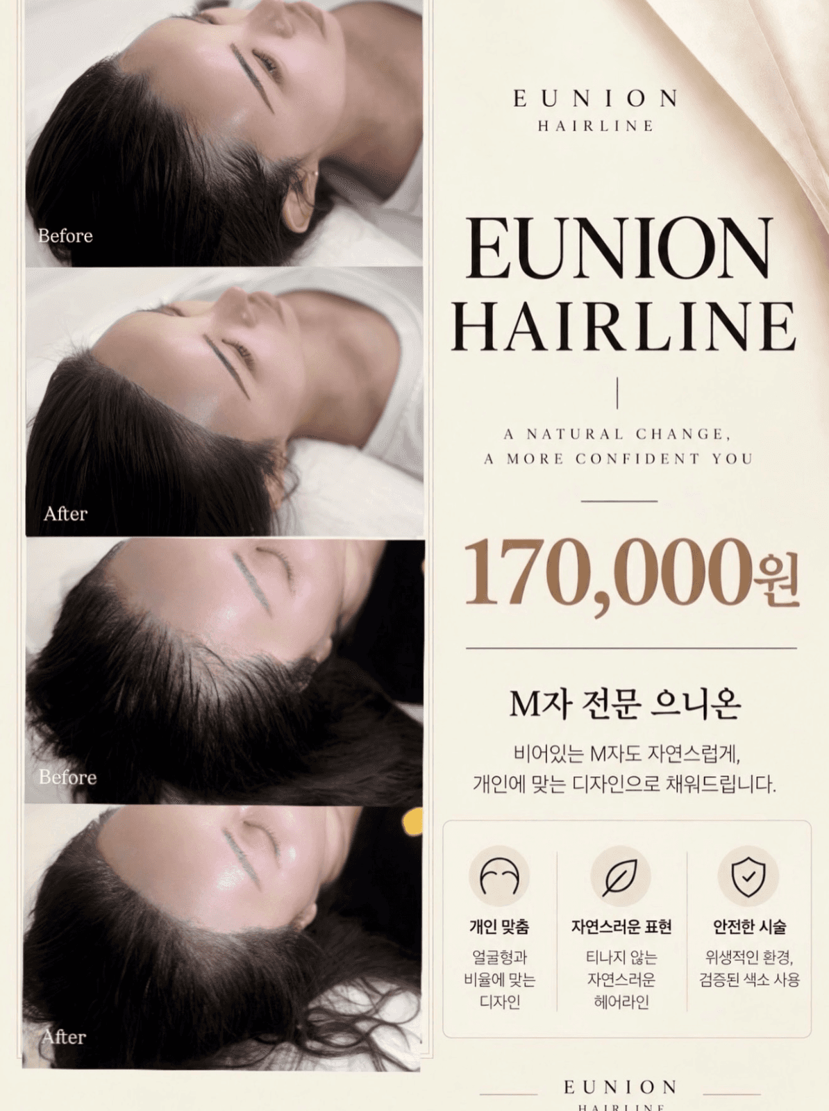 M자 헤어라인 자연스럽게 채우기|10월 마지막 이벤트