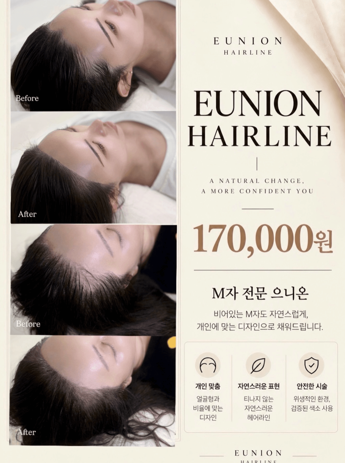 M자 헤어라인 자연스럽게 채우기|10월 마지막 이벤트