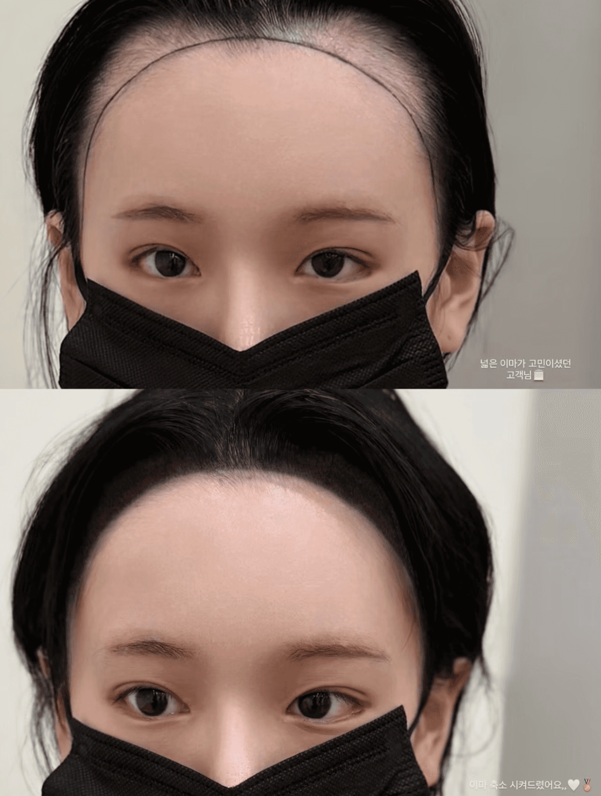 넓은 이마 고민, 헤어라인으로 자연스럽게 변화
