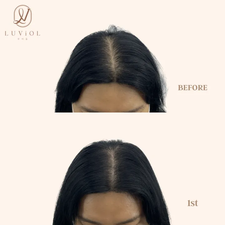 가르마 밀도보강