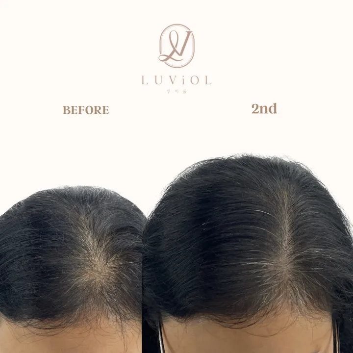 가르마 밀도보강 2차 전후