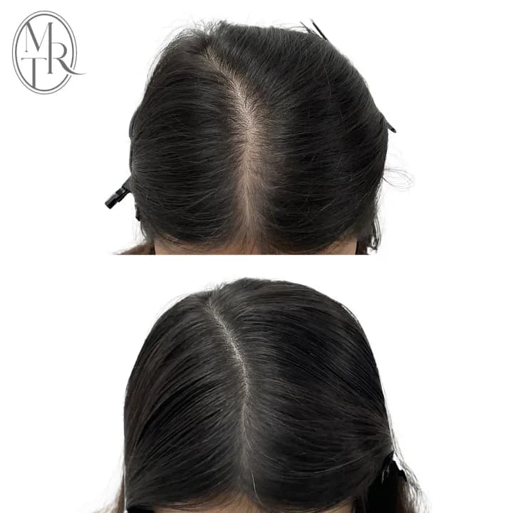 여성가르마탈모커버