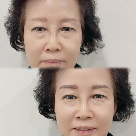 잔흔커버 섀도우